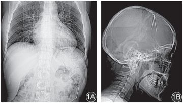 MAROKO133 Eksklusif kesehatan: Foto Rontgen Ini Ungkap Temuan Jarum Misterius di Tubuh Pas